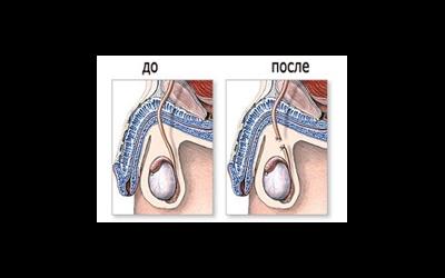 Вазэктомия мужская и женская