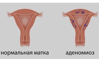 Аденомиоз и успешность ЭКО