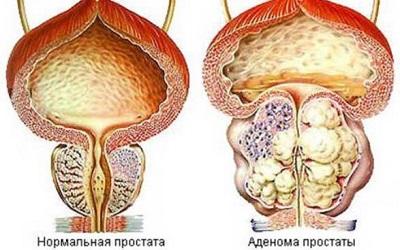 Увеличение предстательной железы