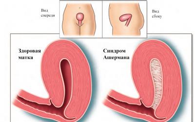 Найдено лечение синдрома Ашермана