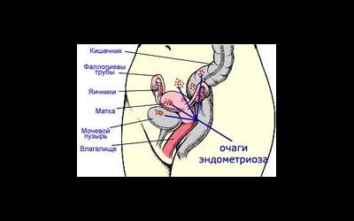 Эндометриоз  - его виды, симптомы и лечение