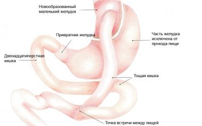 Желудочное шунтирование ухудшает качество спермы