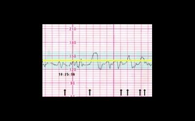 КТГ (кардиотокография)