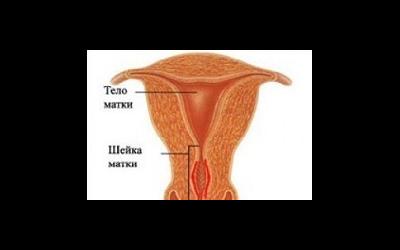 Цервикальный канал матки и проблемы с зачатием