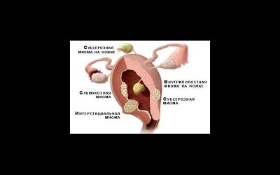 Женские болезни. Миома матки