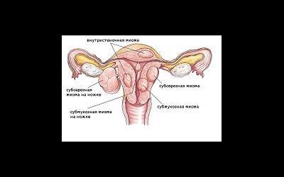 Размеры матки при миоме - диагностика