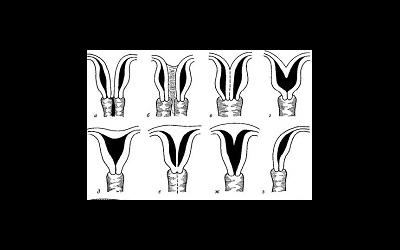 Аномалии развития женских половых органов