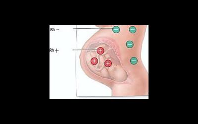 Отрицательный резус-фактор. Особенности и возможные осложнения