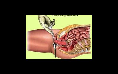 Влагалищная гистерэктомия