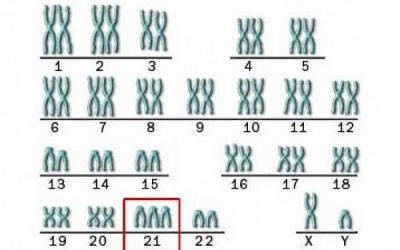 Почему возникает синдром Дауна?