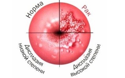 Дисплазия шейки матки