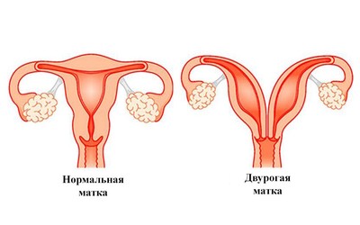 2 матки – 2 ребенка