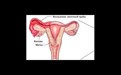 Сальпингоофорит и бесплодие