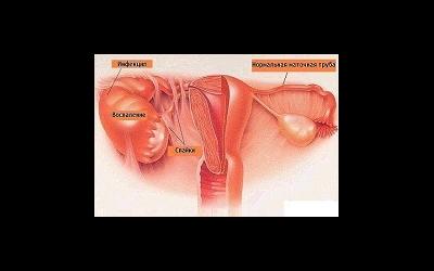 Гидросальпинкс: причины, лечение без операции и способы операбельного лечения