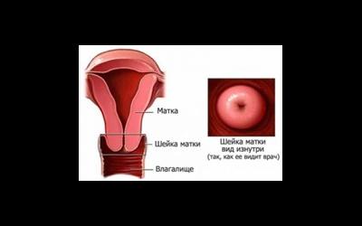 Шейка матки – выворот, воспаление, разрывы
