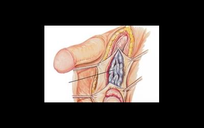 Варикоцеле - что делать?