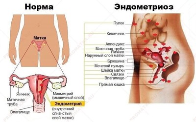 Признаки эндометриоза