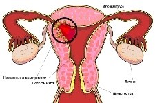 Диффузный эндометриоз тела матки, его признаки и лечение Диффузный эндометриоз тела матки, его признаки и лечение