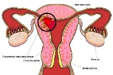 Диффузный эндометриоз тела матки, его признаки и лечение