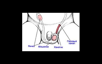 Крипторхизм истинный и ложный
