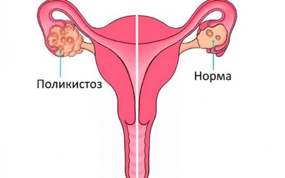 Поликистоз яичников повышает вероятность психического расстройства у женщин 