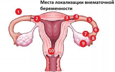 Можно родить ребенка и без матки