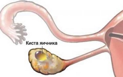 Анэхогенное аваскулярное образование в яичнике: что делать?