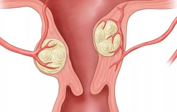 Главная опасность миомы