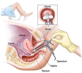 Последствия биопсии шейки матки